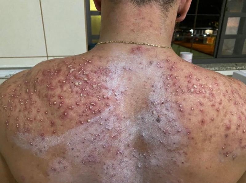 Costas com acne, antes do protocolo Além da Acne