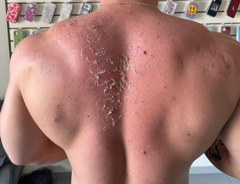 As mesmas costas após seguir o protocolo Além da Acne