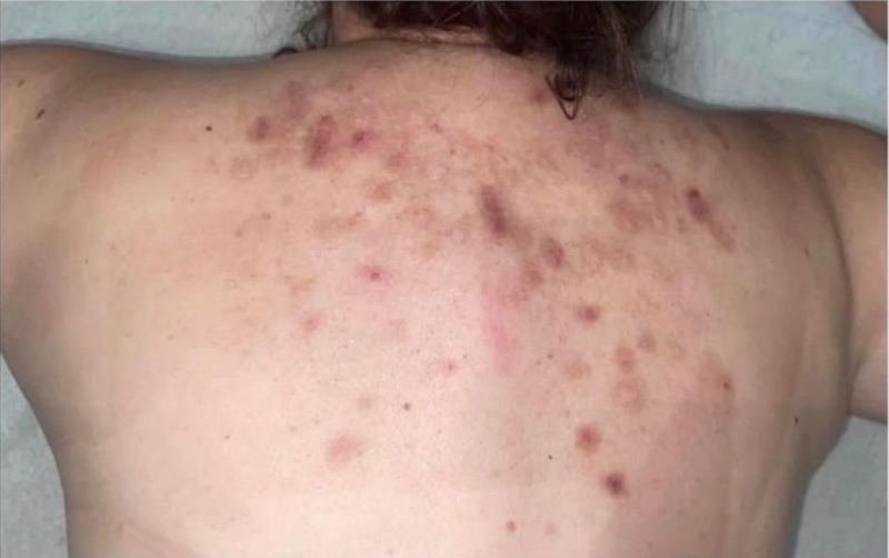 Costas com acne, antes do protocolo Além da Acne