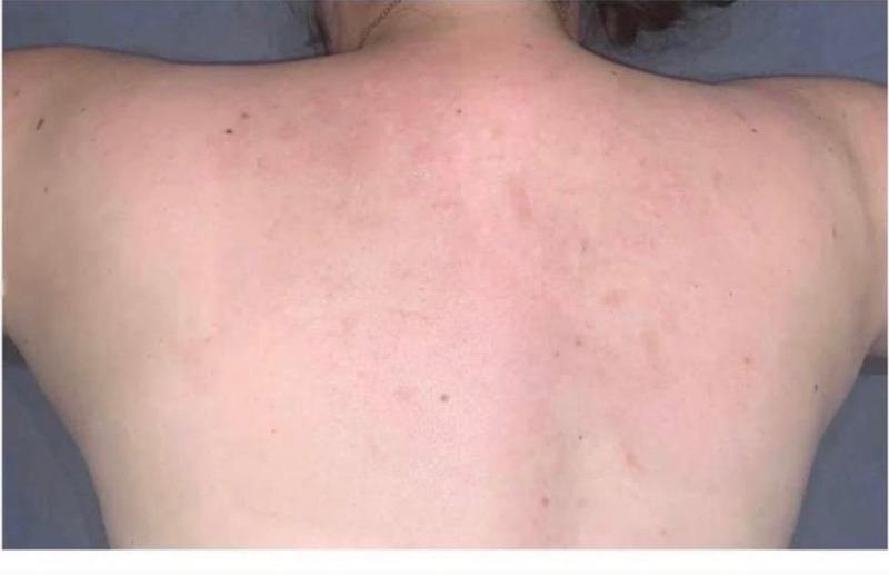 Costas após seguir o protocolo Além da Acne