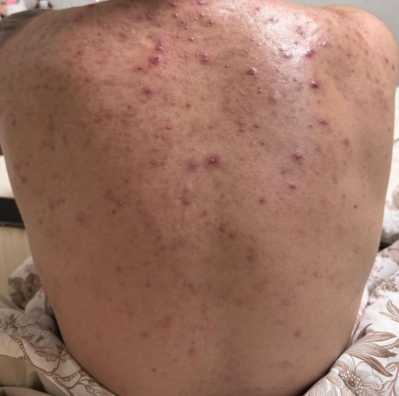 Costas com acne, antes do protocolo Além da Acne