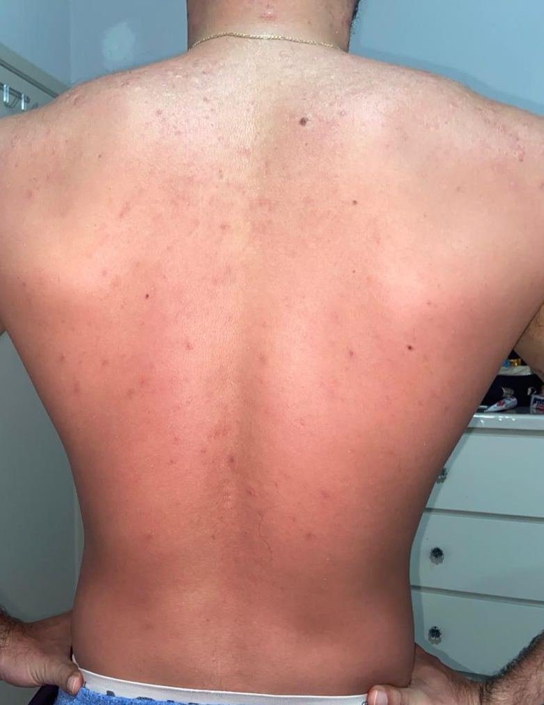 Costas após seguir o protocolo Além da Acne